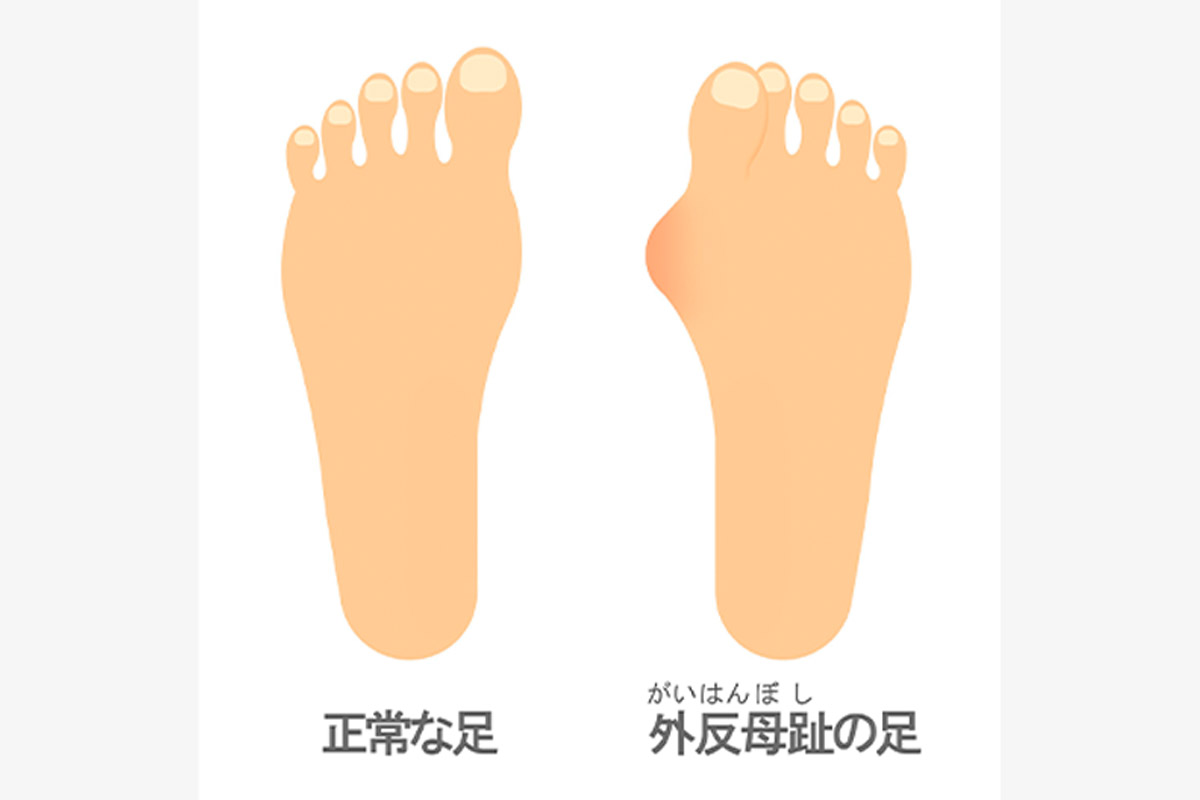 外反母趾は足の親指が人差し指側に“く”の字型に曲がることを指す　画像：PIXTA
